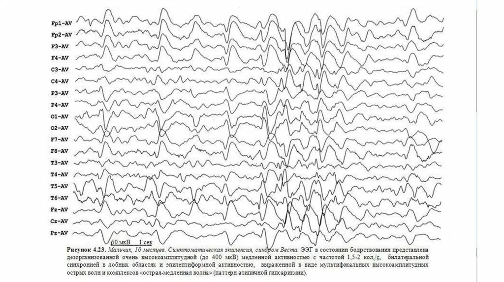 Медленные волны на ээг. Острая волна медленная волна на ЭЭГ. Пик медленная волна на ЭЭГ что это. Комплекс острая медленная волна на ЭЭГ. Эпилептиформная активность на ЭЭГ.
