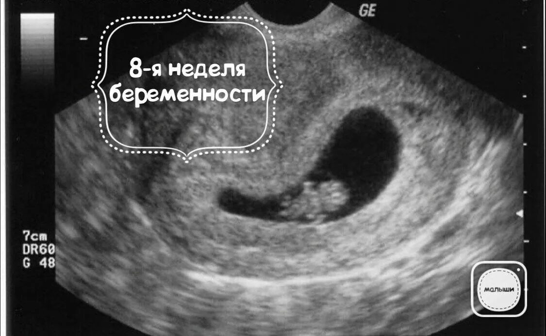 Плод на 8 неделе беременности УЗИ. Как выглядит эмбрион в 8 недель на УЗИ. УЗИ на 8 неделе беременности акушерской. Зародыш 8 недель УЗИ. Тонус 8 недель