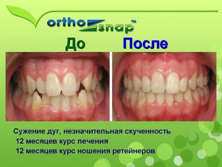 Зубы отзывы тверь. Элайнеры выравнивают зубы. элайнеры для выравнивания.
