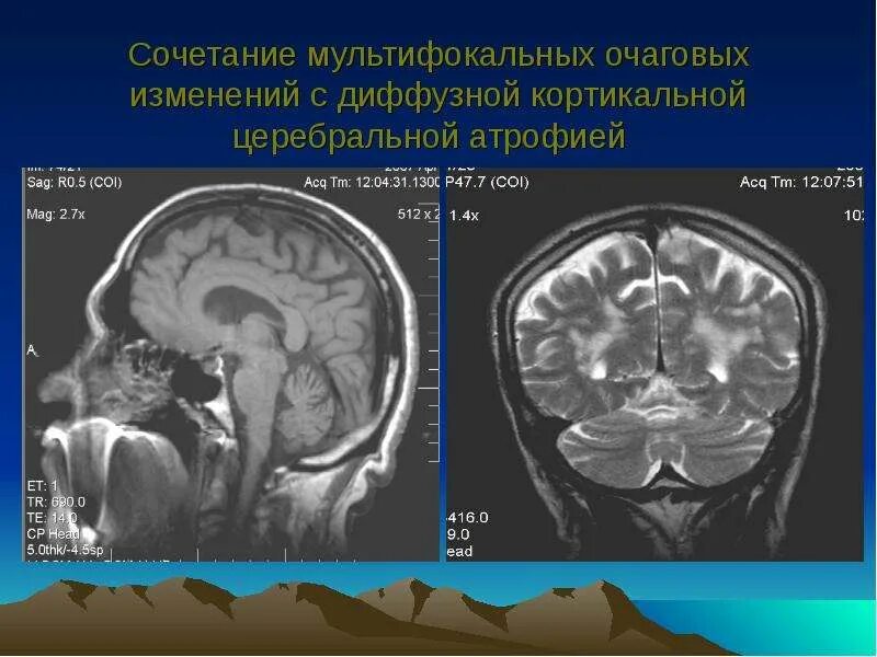 Диффузная церебральная атрофия степени