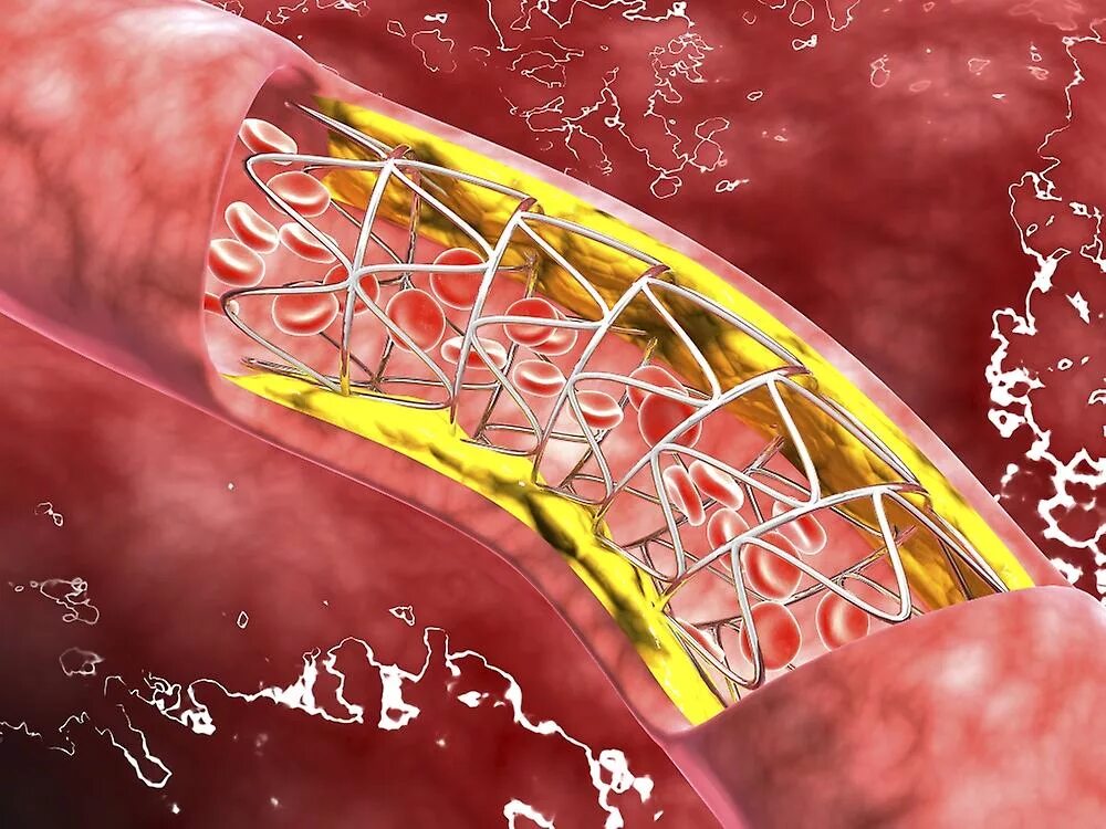 Вставили стент. Инфаркт миокарда стентирование сосудов. Инфаркт и стентирование сосудов сердца.