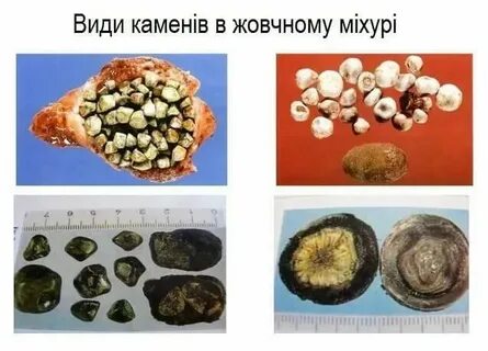 Конкременты в поджелудочной железе