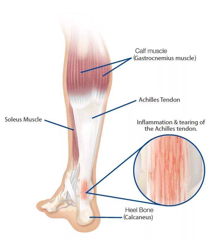 Анатомия ахиллова сухожилия. Ахиллово сухожилие анатомия. Ахиллово сухожилие на стопе.