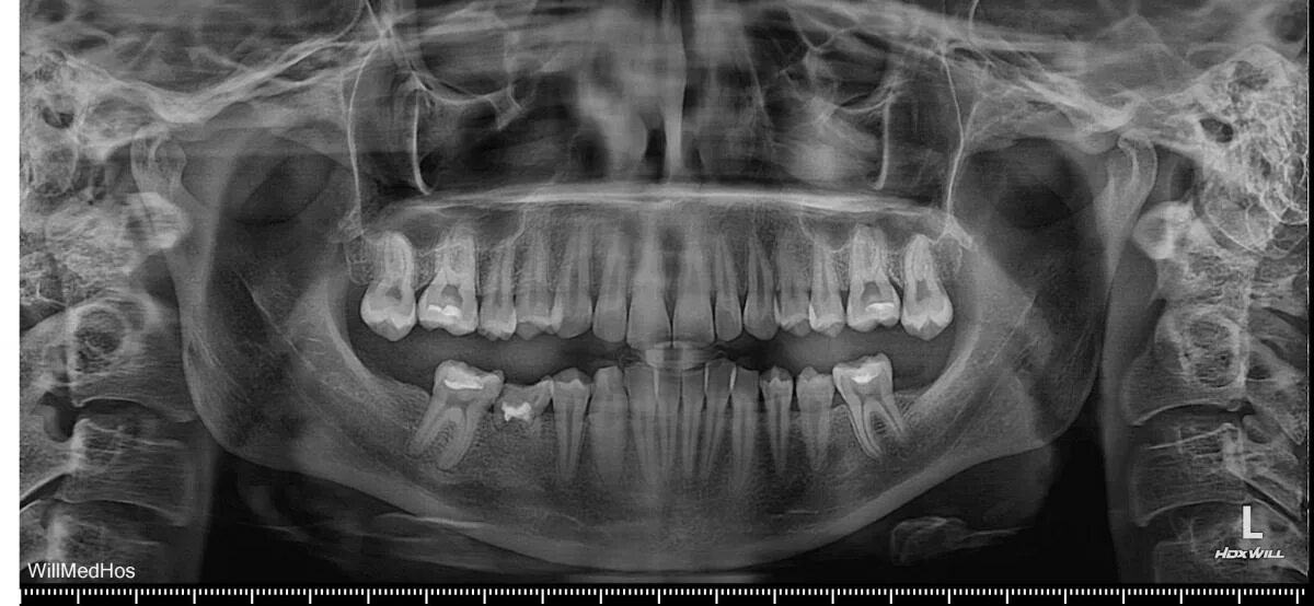 Снимок зубов видное. Панорамный снимок зубов ОПТГ. Рентген зубов панорамный.