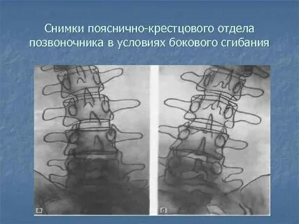 Карте поясничного отдела позвоночника