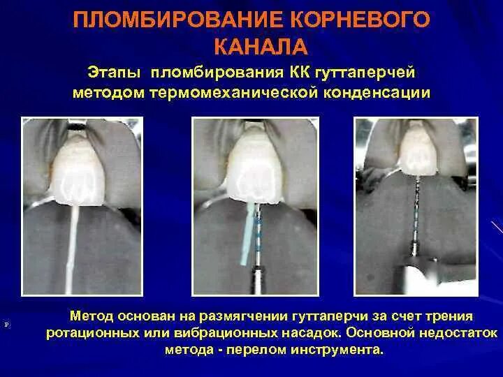 При пломбировании корневого канала используют инструмент. При пломбировании корневого канала используют инструмент