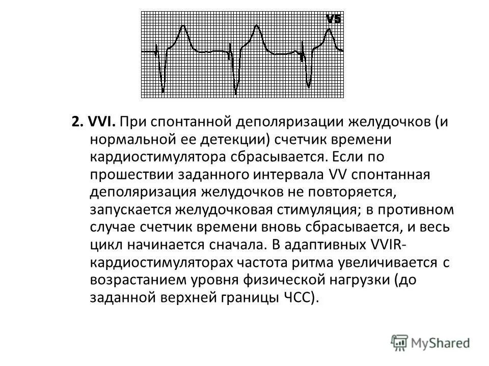 Кардиостимулятор при каком пульсе