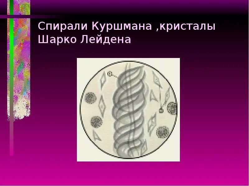 Кристаллы шарко лейдена. Спирали куршмана и кристаллы шарко-лейдена. спирали куршмана и кристаллы шарко-лейдена в мокроте. кристаллы шарко-лейдена в мокроте. куршмана и шарко лейдена.