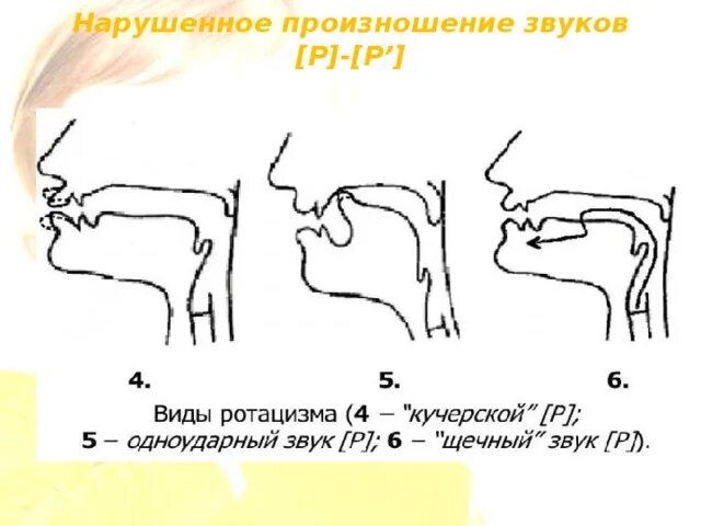 Боковой ротацизм. Неправильное произношение звука р. Велярный ротацизм. Велярный ротацизм артикуляционный профиль звука. Правильная постановка языка при произношении буквы р.