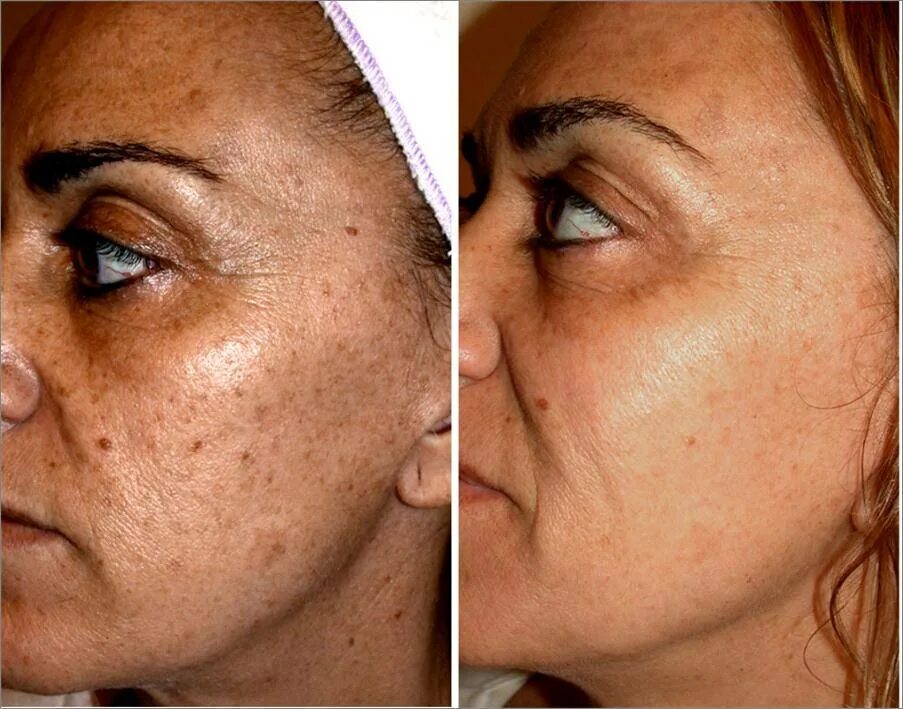 До и после от пигментации отзывы Service Spotlight: I.P.L Treatments (Intense Pulsed Light) Spa, Web design