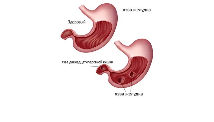 Почему рвота с кровью. Язва желудка рвота с кровью. рвота при язвенной болезни желудка.