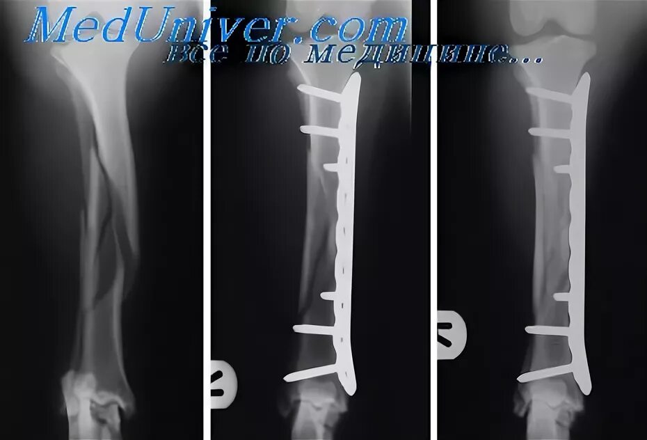 Резкий крутой перелом в чем нибудь. Синостоз костей голени рентген. Ложный сустав после перелома плечевой кости. Ложный сустав плечевой кости. Неправильно сросшийся перелом плечевой кости.