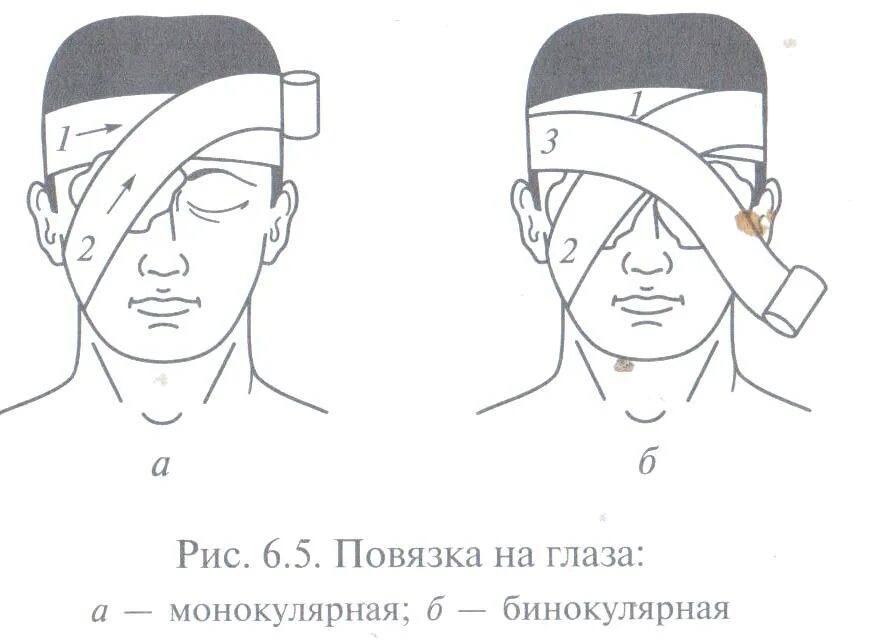 Наложение бинокулярной повязки на оба глаза. Десмургия бинокулярная повязка. Наложение бинокулярной повязки алгоритм. Техника наложении повязки на глаз монокулярная.