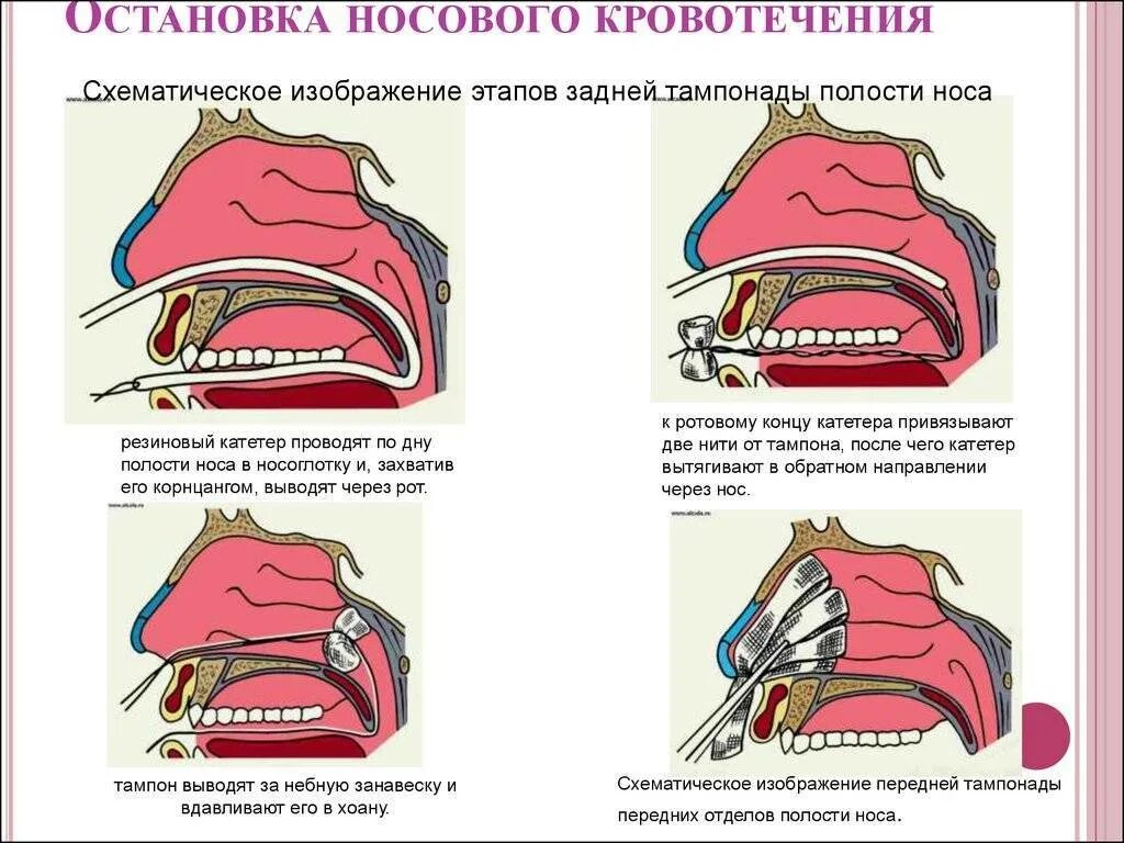 Пошла сильно кровь. Остановкакровотеечния износма. Остановка носового кровотечения. Нососове кровотечение.