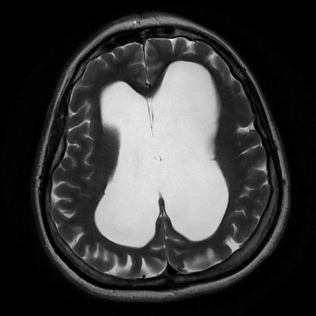 Гидроцефалия головного мозга мрт. Заместительная гидроцефалия на мрт. Наружная гидроцефалия мрт. Окклюзионная гидроцефалия мрт.