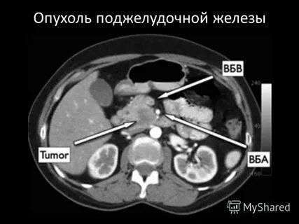 Рак поджелудочной железы метастазы