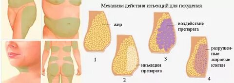 Инъекции для похудения отзывы
