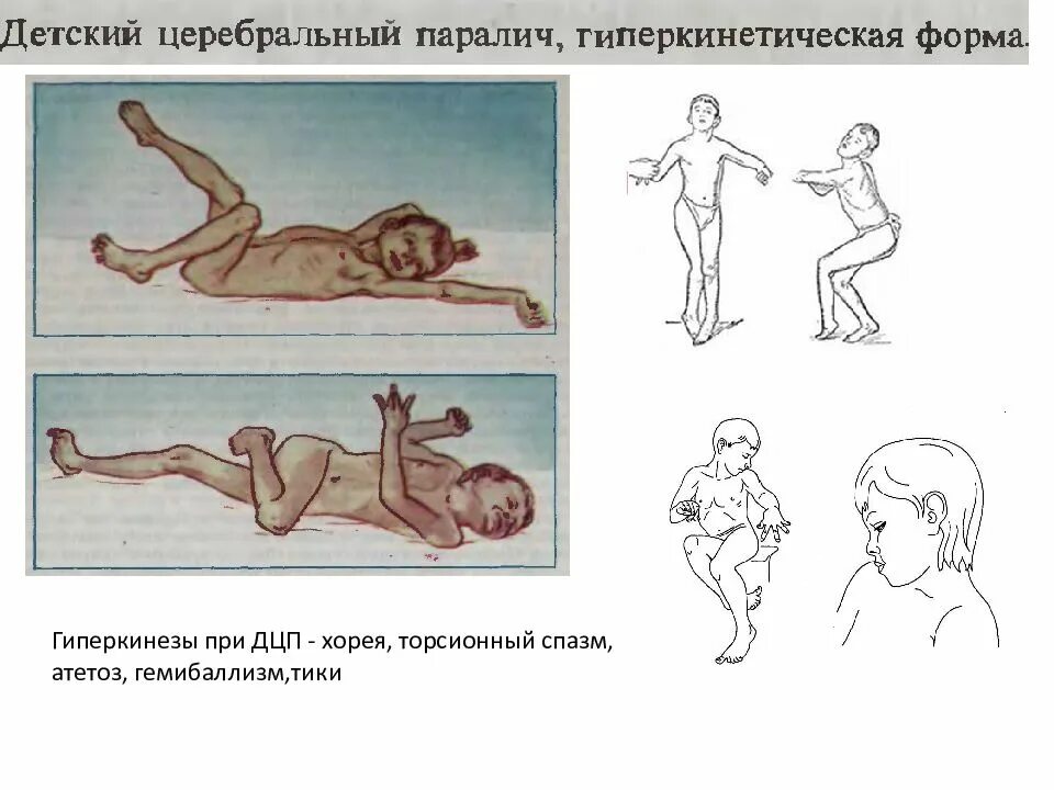 Гиперкинетическую дцп. ДЦП гиперкинетическая форма неврология. Дискинетическая форма ДЦП. Детский церебральный паралич гиперкинетическая форма.