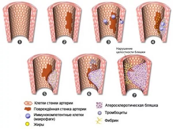 Атеросклеротическая бляшка концентрическая это. Стенозирующий атеросклероз. Стенозирующий и нестенозирующий атеросклероз. Стенозирующий атеросклероз стадии.