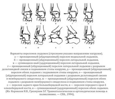 Через сколько операция перелом