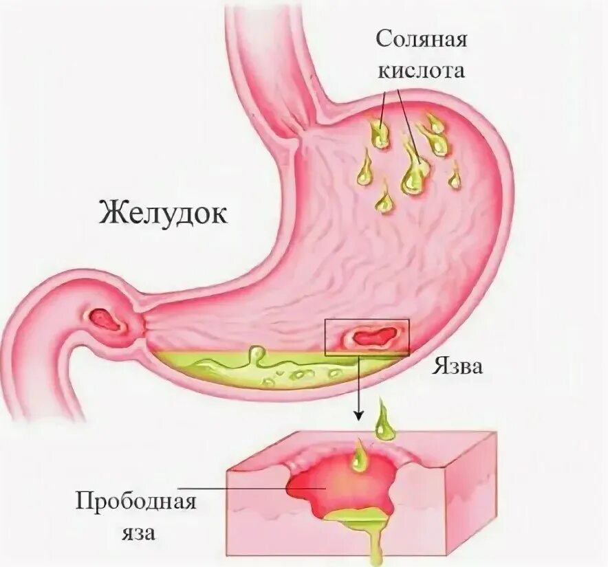 Язвенная болезнь желудка прободение. • Прободение язвы язвы 12 перстной Кишк. Прободение при язвенной болезни желудка. Перфорация язвы 12 перстной кишки. Как проверить язву