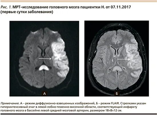 Диффузные изменения головного мозга. Диффузные изменения головного мозга