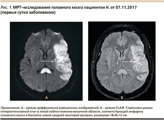 Субатрофические изменения мозга