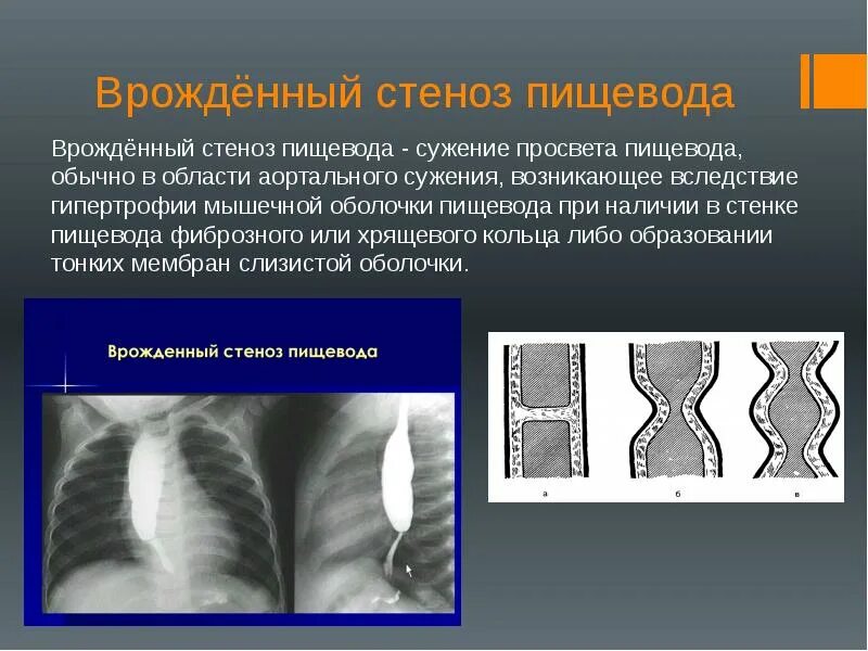 Просвет пищевода. Врожденный стеноз пищевода. Врожденный короткий пищевод рентген. Врожденный короткий пищевод.