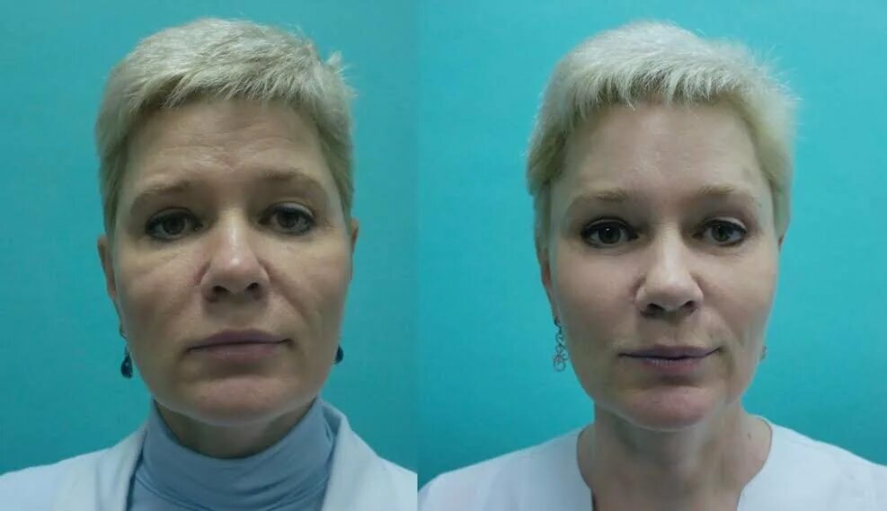 Как снять отек лица после запоя