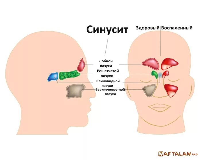 Носовые пазухи психосоматика. Острые и хронические синуситы. Психосоматика нос гайморит.