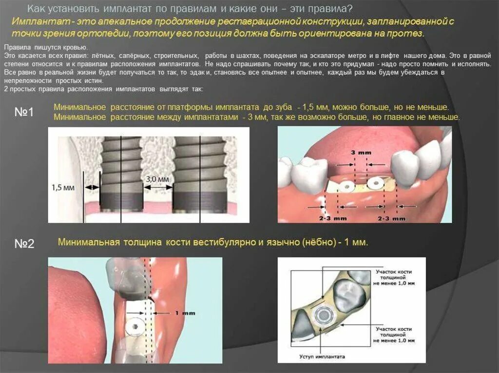 Этапы имплантации зубов. Этапы установки имплантата. Имплантация sup aznona com