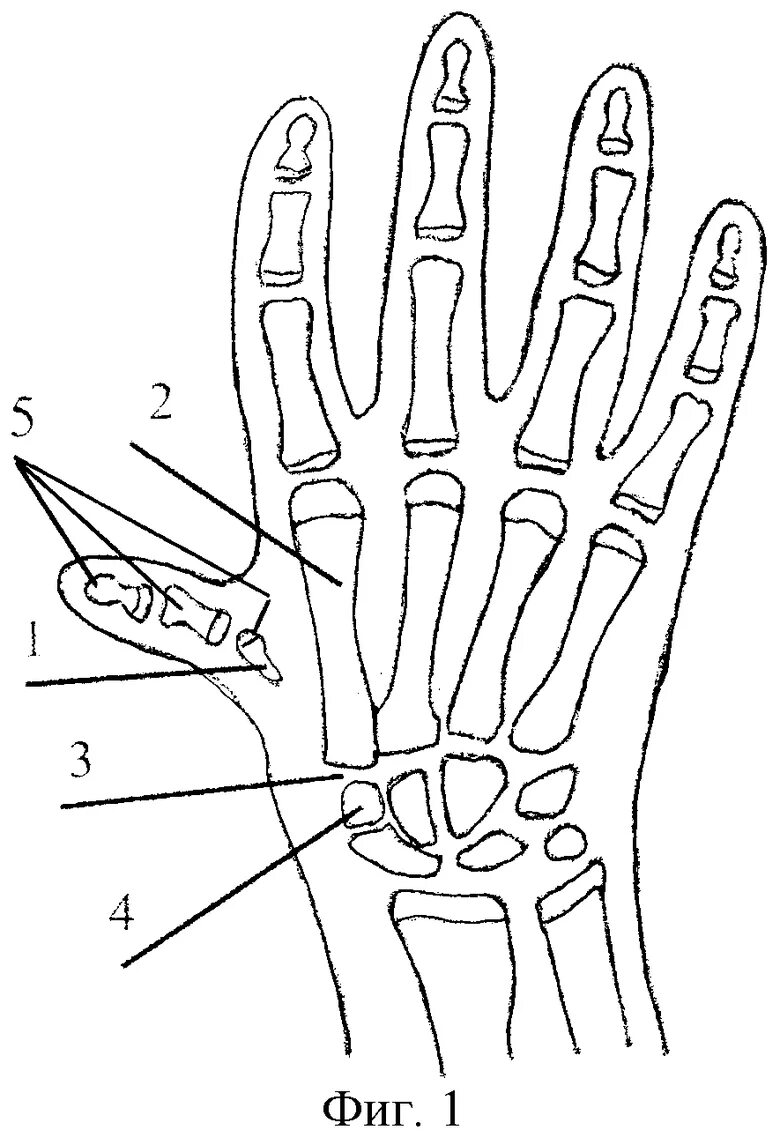 Пальцев 1 том. Гипоплазия 1 пальца кисти. Гипоплазия фаланги пальцев. Гипоплазия пястной кости. Недоразвитие пястных костей.