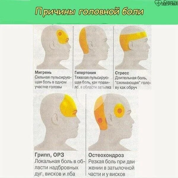 Схема локализации головной боли. Причины головной боли. Боль под затылком