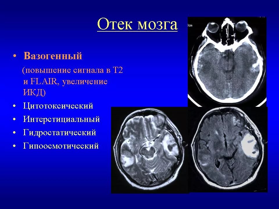 Смерть от отека мозга. Вазогенный отек головного мозга кт. Цитотоксический отёк головного мозга кт. Цитотоксический отек мозга на кт. Диагностические критерии отека головного мозга.