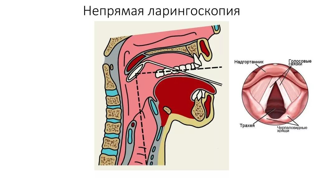 Гортань клиника. Ларингоскопия надгортанника. Непрямая ларингоскопия (гипофарингоскопия). Гортань при непрямой ларингоскопии. Ларингоскопия при стенозе.