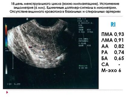 Кровоточит эндометрий