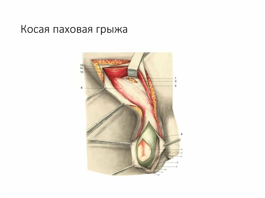 Косая вправимая паховая грыжа. Правосторонняя косая паховая грыжа. Ущемленная левосторонняя косая паховая грыжа. Косая паховая грыжа хирургическая анатомия. Прямая и косая паховые грыжи