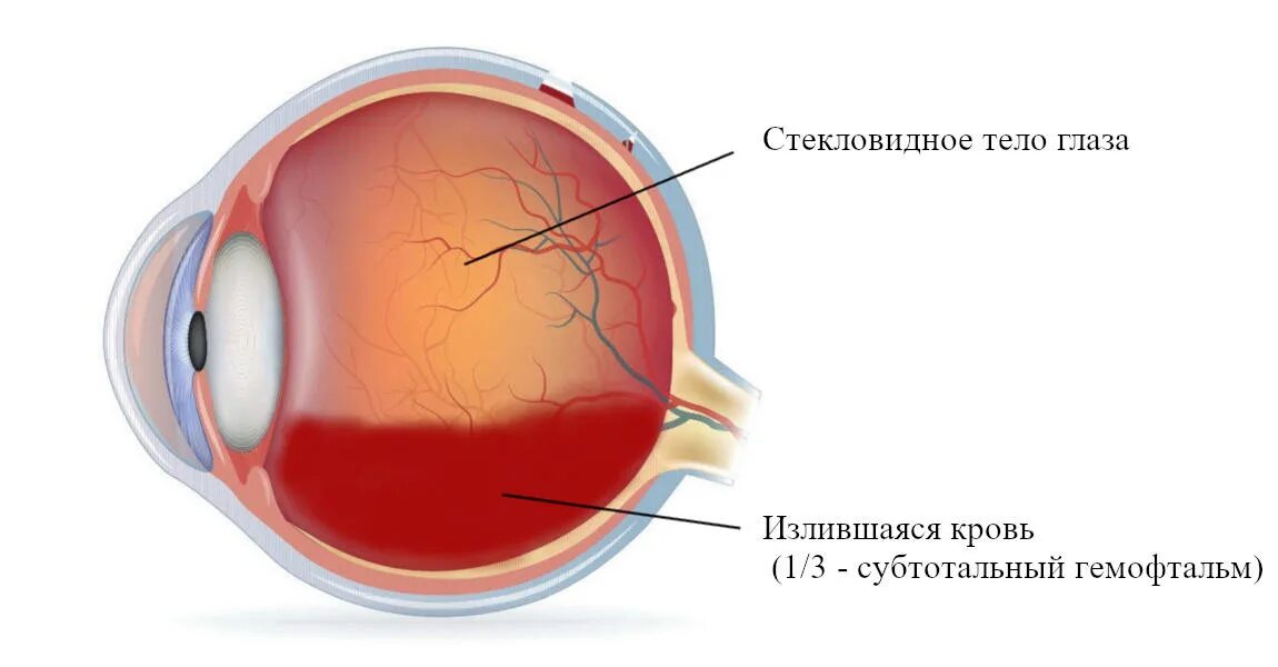 Субконъюнктивальное геморрагии. Кровоизлияния гемофтальм. Гемофтальм стекловидного тела.
