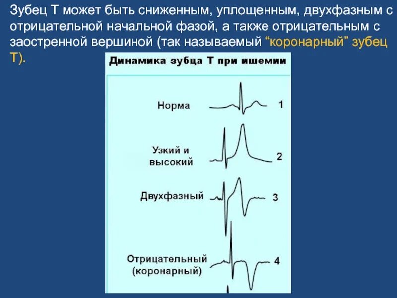 Изменение зубца q. Отрицательный зубец т в 3 отведении на ЭКГ. Отрицательные зубцы т на ЭКГ В v2 v5. ЭКГ отрицательный зубец т в v1-v3. ЭКГ высокий зубец т v2-v4.