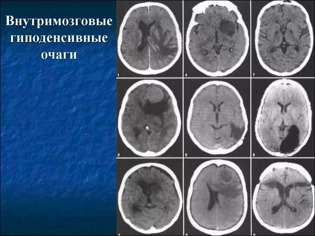 Глиоз в веществе головного мозга что такое. Глиоз головного мозга кт. Гиперденсивное образование головного мозга. Очаги глиоза на кт. Перивентрикулярный очаг головного мозга.