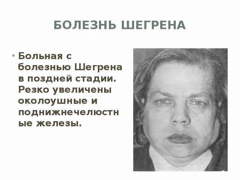 Синдром Гужеро Шегрена. Болезнь и синдром Шегрена. Болезнь Гужеро Шегрена. Синдром шегрена простыми