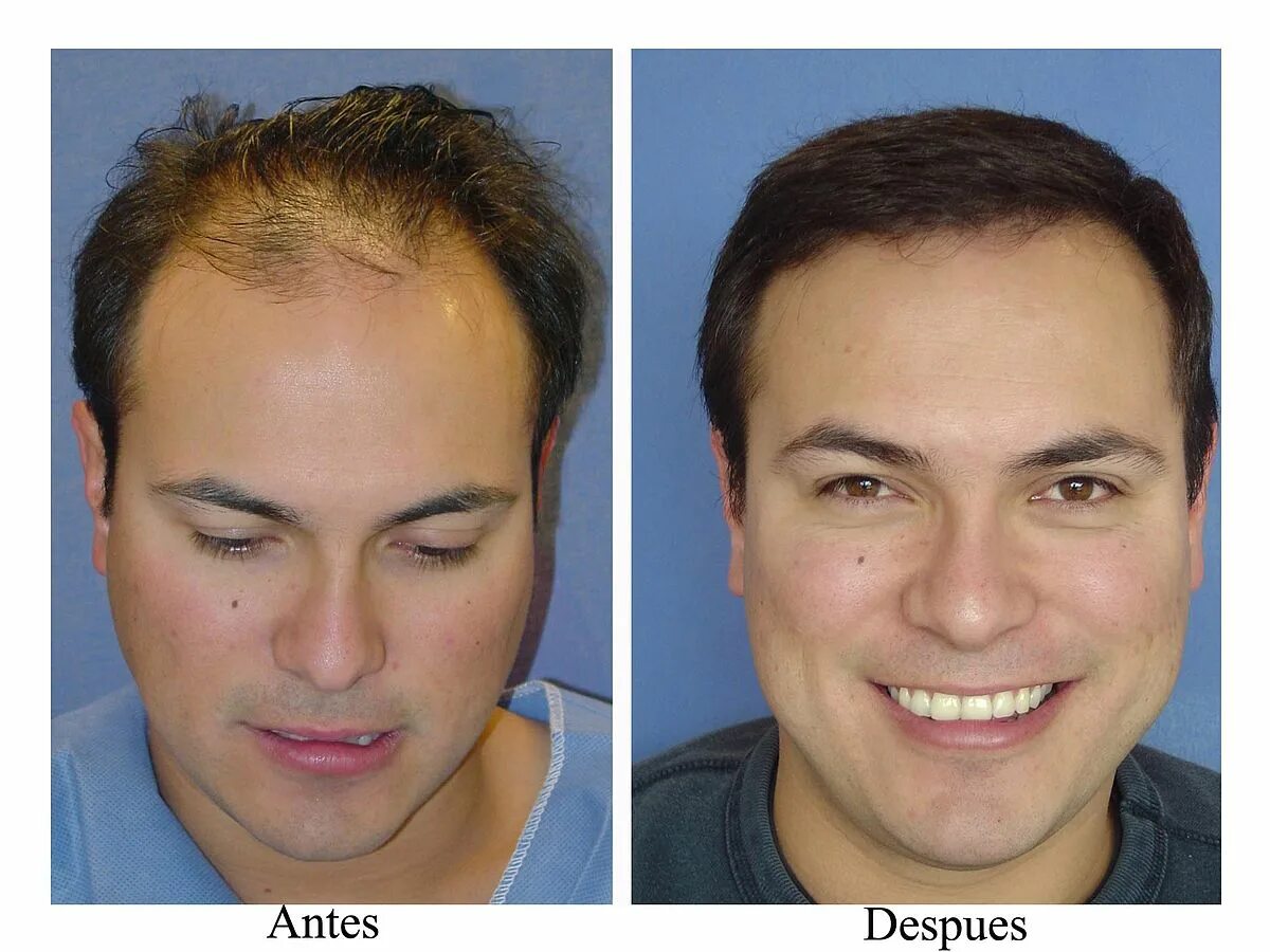 Месяц после пересадки. Пересадка волос до и после. Трансплантация волос до и после. До и после пересадки волос мужчинам. Фото до и после пересадки волос.