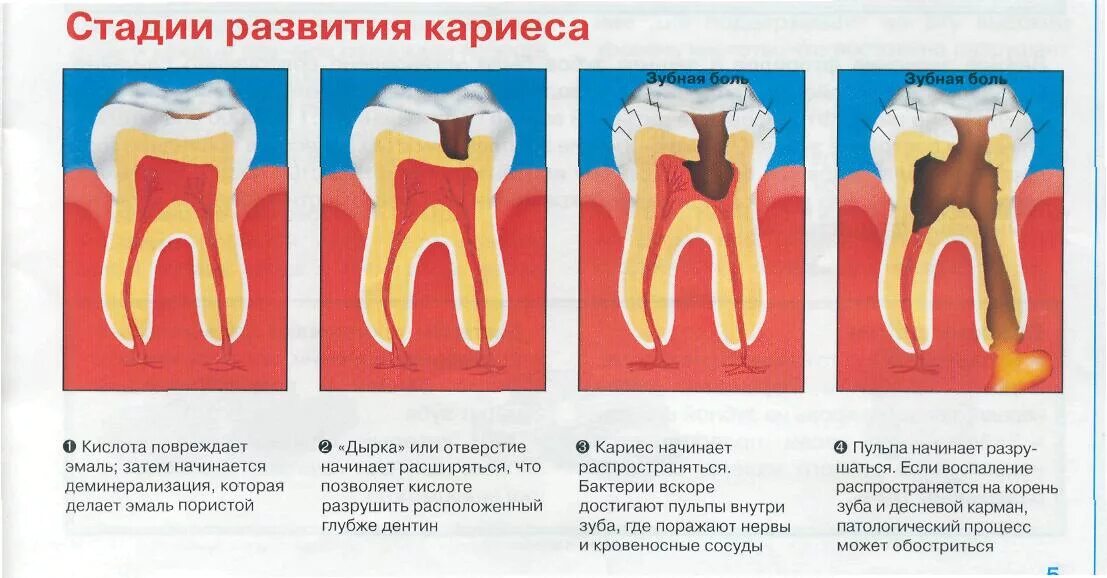 Строение зуба кариес пульпит. Кариес причины возникновения. Стадии формирования кариеса. Зубы болят и сверху и снизу