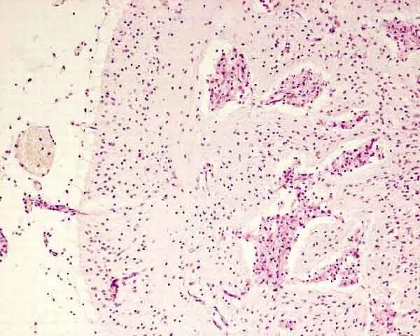 Микропрепарат головного мозга. Врожденный токсоплазмоз микропрепарат. Токсоплазмоз головного мозга гистология. Врожденный токсоплазмоз макропрепарат. Токсоплазмоз мозга микропре.