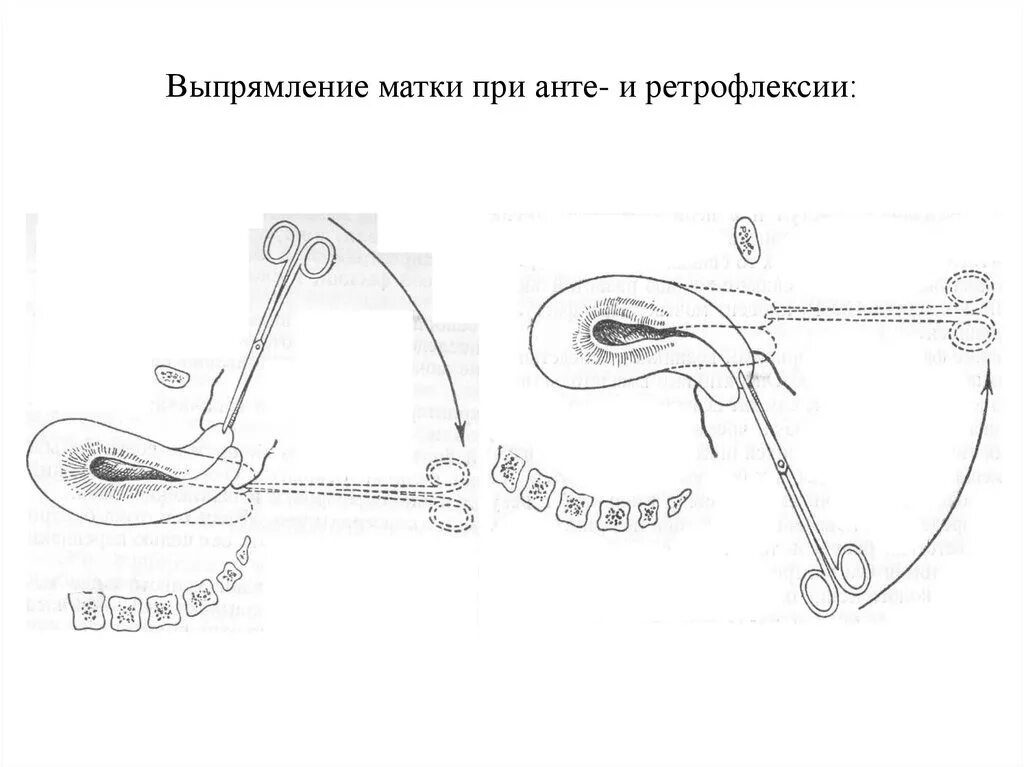 Загиб матки кзади. Варианты положения матки. Неправильное положение половых органов. Ретрофлексия матки.