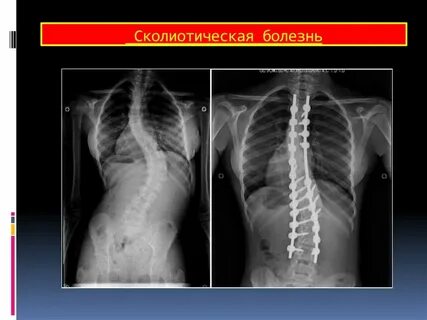 Врожденные заболевания костей