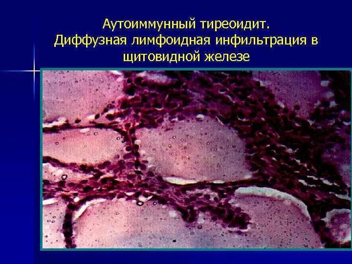 Аутоиммунный тиреоидит. Инфильтрация щитовидной железы. Аутоиммунные заболевания щитовидной железы. Аутоиммунный тиреоидит щитовидной железы что это такое. Диффузный аутоиммунном тиреоидите