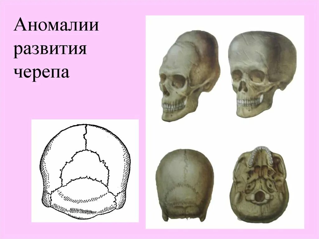 Черепная аномалия. Аномалии развития костей мозгового черепа. Вормиевы кости черепа аномалия. Аномалии развития костей лицевого черепа. Патологии развития костей черепа.