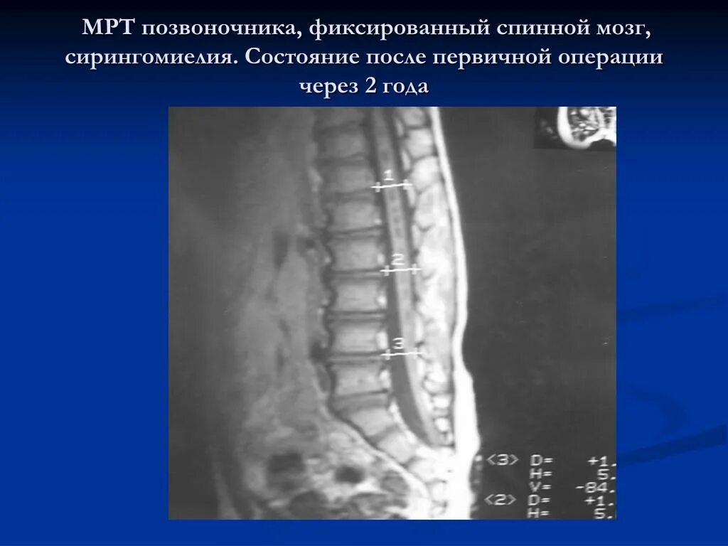 Синдром фиксации спинного мозга. Фиксированный спинной мозг мрт медунивер. Фиксация терминальной нити спинного мозга. Синдром фиксированного спинного мозга у детей.