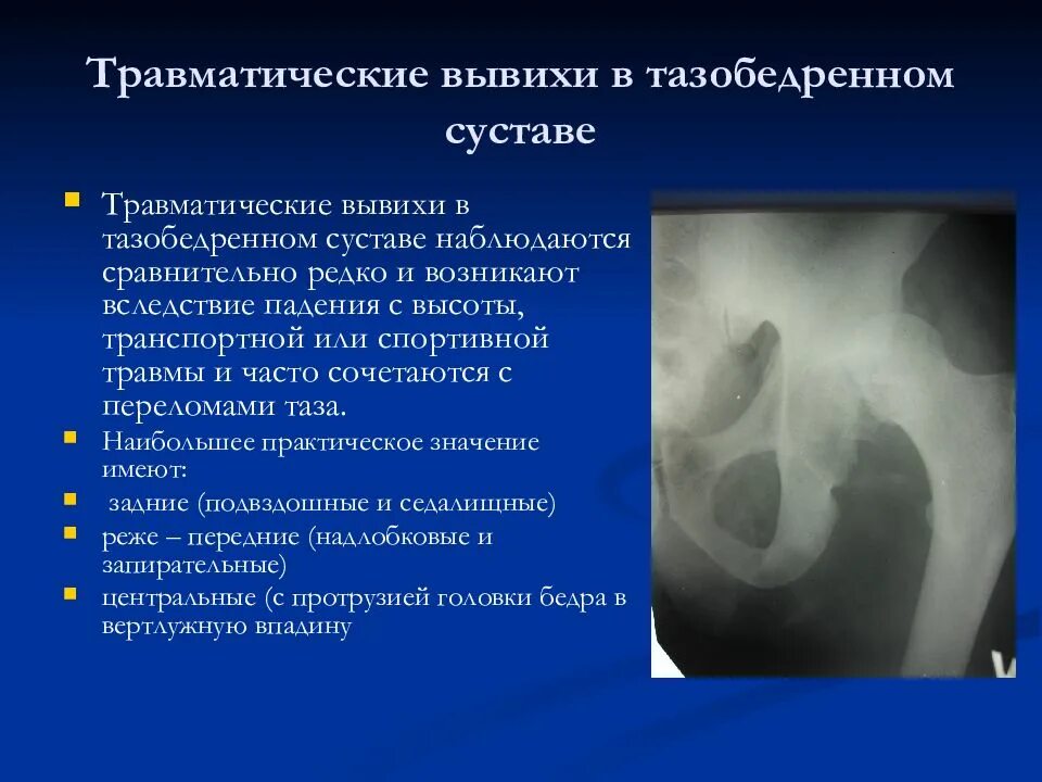 Вывих тазобедренного сустава аксиальная проекция. Подвывих тазобедренного сустава мрт. Подвывих головки бедренной кости классификация. Вывих головки бедренной кости.